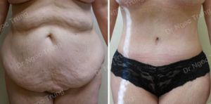 Tạo hình thành bụng nữ 47 tuổi, Dr Ngọc Trung - ca 6