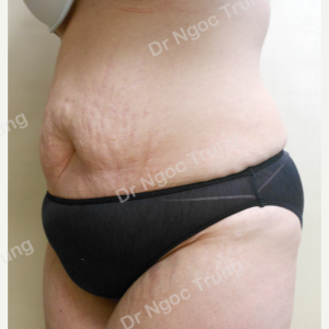 Tạo hình thành bụng nữ 36 tuổi, Dr Ngọc Trung - ca 7