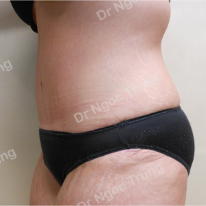Tạo hình thành bụng nữ 36 tuổi, Dr Ngọc Trung - ca 7