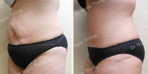 Tạo hình thành bụng nữ 36 tuổi, Dr Ngọc Trung - ca 7