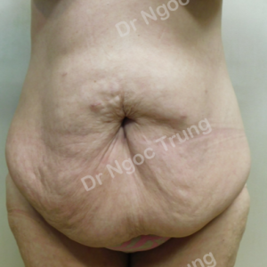 Tạo hình thành bụng nữ 42 tuổi Dr Ngọc Trung - ca 8