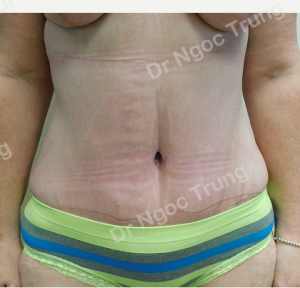 Tạo hình thành bụng nữ 42 tuổi Dr Ngọc Trung - ca 8