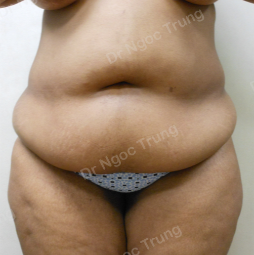 Tạo hình thành bụng nữ 48 tuổi Dr Ngọc Trung - ca 9