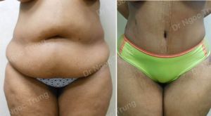 Tạo hình thành bụng nữ 48 tuổi Dr Ngọc Trung - ca 9