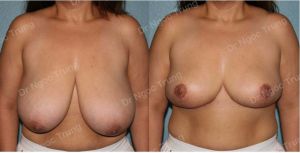 Thu nhỏ ngực phì đại nữ 39 tuổi - ca 52