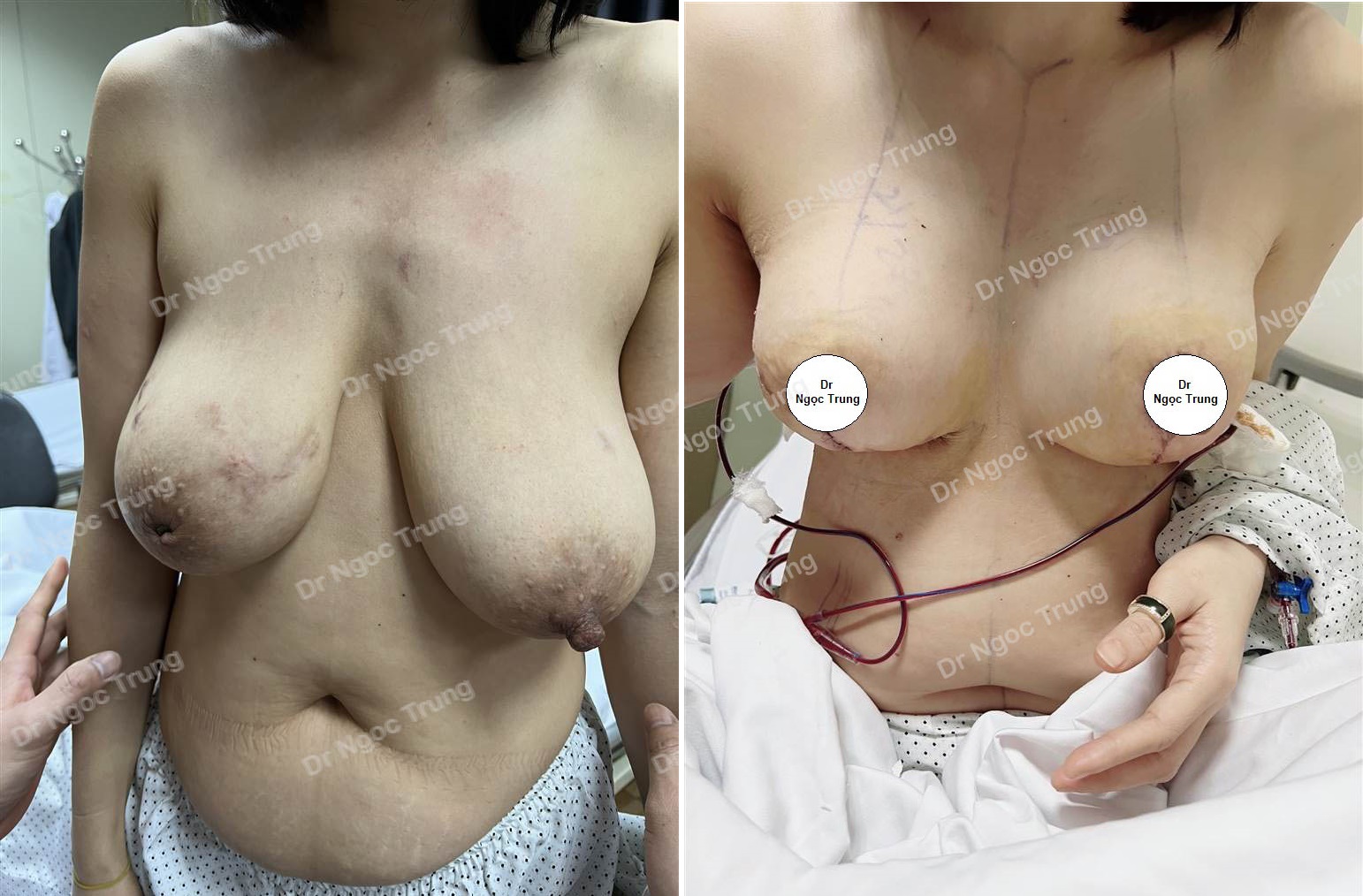 Thu nhỏ ngực phì đại, nữ 35 tuổi, TP.HCM - ca 51