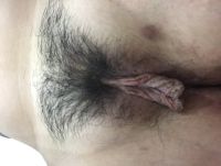 Môi bé dài,thừa, chưa sinh con có nên cắt môi tạo hình môi không?