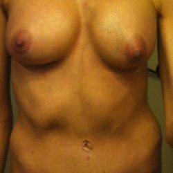 Làm thế nào để thu nhỏ lỗ rốn cho nó đẹp hơn và làm cân đối hai bên ngực đây?