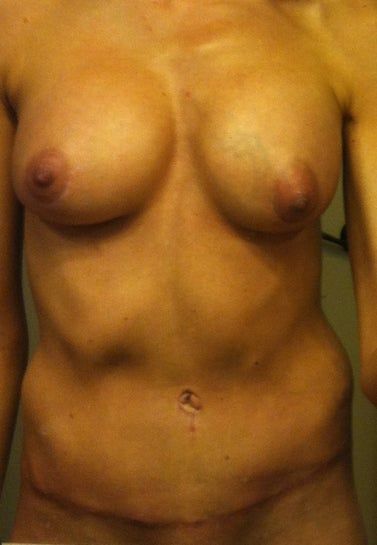 Làm thế nào để thu nhỏ lỗ rốn cho nó đẹp hơn và làm cân đối hai bên ngực đây? Làm thế nào để thu nhỏ lỗ rốn cho nó đẹp hơn và làm cân đối hai bên ngực đây?