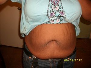 Làm cùng lúc tạo hình thành bụng và thu nhỏ ngực có an toàn không?