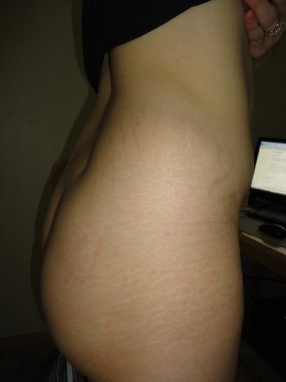 Tôi có thể làm tạo hình thành bụng mở rộng kèm nâng mông để xóa những vết rạn bên hông không?
