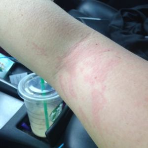 Tôi phát ban khắp cơ thể một tuần sau khi phẫu thuật combo ngực bụng, tôi cần lời khuyên?