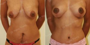 Combo ngực bụng, nữ 37 tuổi, Dr Ngọc Trung - ca 6