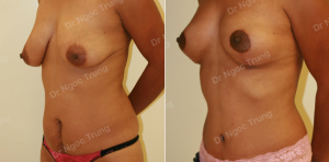 Combo ngực bụng, nữ 37 tuổi, Dr Ngọc Trung - ca 6