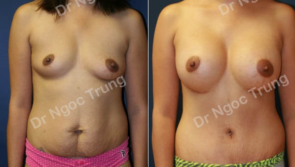 Combo ngực bụng nữ 26 tuổi, Dr Ngọc Trung - ca 7