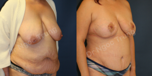 Combo ngực bụng Dr Ngọc Trung - ca 8