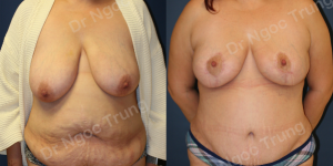 Combo ngực bụng Dr Ngọc Trung - ca 8