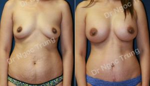 Combo ngực bụng Dr Ngọc Trung - ca 9