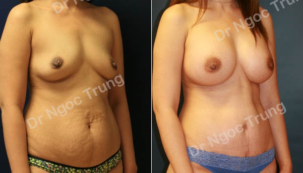 Combo ngực bụng Dr Ngọc Trung - ca 9
