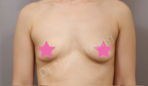 Nâng ngực Dr Ngọc Trung - ca 70