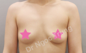 Nâng ngực Dr Ngọc Trung - ca 71
