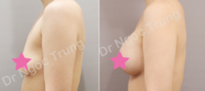 Nâng ngực Dr Ngọc Trung - ca 71