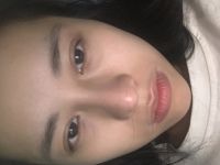 Nâng mũi bọc sụn megader
 6 tháng đầu mũi vẫn to và cứng