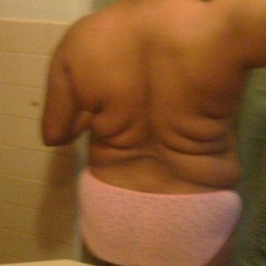 Tôi 32 tuổi, cao 1m76 và nặng 94 kg, tôi có thể làm combo ngực bụng không?