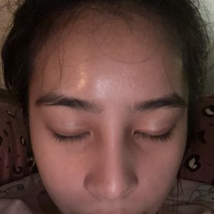 Mũi 8 tháng bị sưng do bầu hay do dị ứng chất liệu hay nhiễm trùng ạ ?