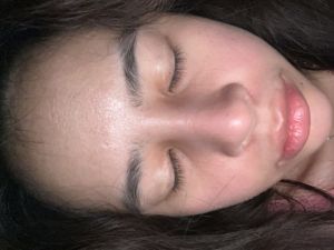 Mũi 8 tháng bị sưng do bầu hay do dị ứng chất liệu hay nhiễm trùng ạ ?