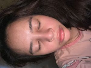 Mũi 8 tháng bị sưng do bầu hay do dị ứng chất liệu hay nhiễm trùng ạ ?