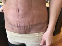 Đã 6 tuần sau phẫu thuật thì liệu còn có thể bị đau nữa không?