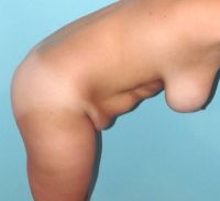 Tôi muốn bụng đẹp hơn và treo cao ngực, tôi nên làm thủ thuật thẩm mỹ gì?