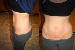 Liệu combo ngực bụng có làm cơ thể tôi đẹp hơn so với lúc trước khi mang thai không?