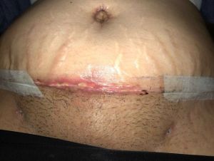 Xin hãy xem ảnh và cho tôi biết liệu có phải tôi đã bị nhiễm trùng hoặc tụ dịch sau Combo ngực bụng hay không?