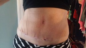 Trông vết mổ của tôi có bình thường không, tôi làm combo ngực bụng 26 ngày trước và rất sợ bị hoại tử?