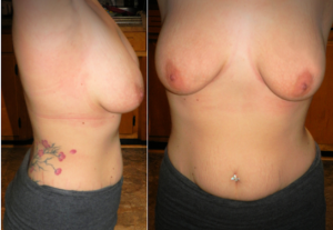 Liệu combo ngực bụng có làm cơ thể tôi đẹp hơn so với lúc trước khi mang thai không?