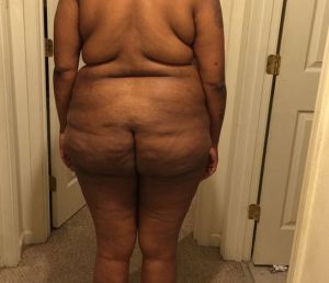 Tôi muốn làm combo ngực bụng ở tuổi 34, nặng 108 kg và cao 1m76, thì có được không?