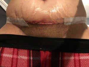 Xin hãy xem ảnh và cho tôi biết liệu có phải tôi đã bị nhiễm trùng hoặc tụ dịch sau Combo ngực bụng hay không?