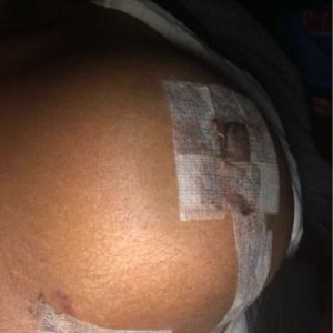 Đã 10 ngày kể từ khi tôi làm Combo ngực bụng, liệu đây có phải là dấu hiệu của tụ máu?