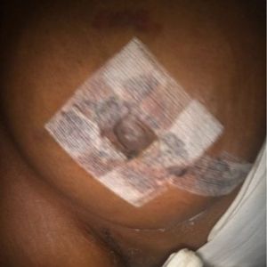 Đã 10 ngày kể từ khi tôi làm Combo ngực bụng, liệu đây có phải là dấu hiệu của tụ máu?