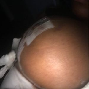 Đã 10 ngày kể từ khi tôi làm Combo ngực bụng, liệu đây có phải là dấu hiệu của tụ máu?