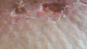 Tóc mọc ra từ vết thương hở sau ba tuần kể từ khi làm combo ngực bụng?