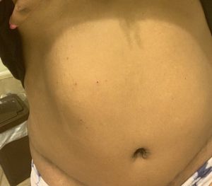 Tôi đã làm Combo ngực bụng cách đây 1 năm 3 tháng, đến nay nửa trên của bụng vẫn lồi ra và đã bị tụ máu, tôi có phải làm phẫu thuật lại hay không?