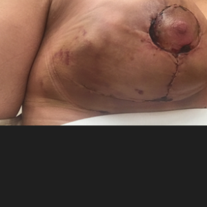 Tôi bị tụ máu hay bầm tím bình thường?