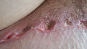 Tóc mọc ra từ vết thương hở sau ba tuần kể từ khi làm combo ngực bụng?