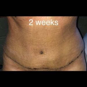Đã làm Combo ngực bụng được 4 tuần, sưng ngày càng nhiều và rốn như đang khép lại, có đáng lo hay không?
