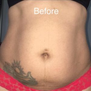 Đã làm Combo ngực bụng được 4 tuần, sưng ngày càng nhiều và rốn như đang khép lại, có đáng lo hay không?