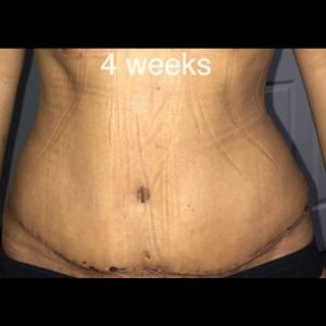 Đã làm Combo ngực bụng được 4 tuần, sưng ngày càng nhiều và rốn như đang khép lại, có đáng lo hay không?