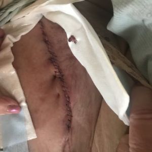 Vết mổ tạo hình thành bụng bị chảy máu thì có phải nó sắp bục ra không?